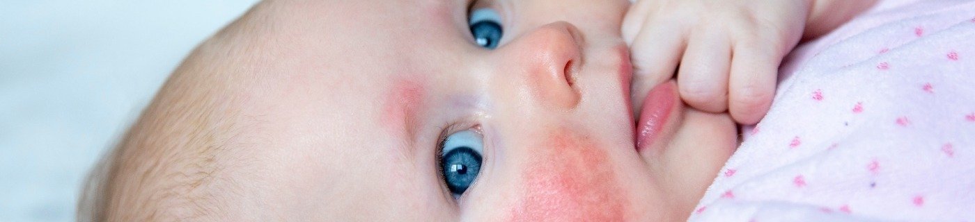 10 Penyebab Bruntusan pada Bayi dan Cara Ampuh Mengatasinya