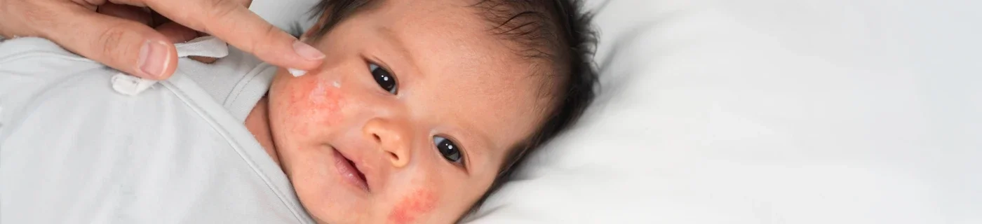 Penyebab, Ciri, dan Cara Mengatasi Eksim pada Bayi