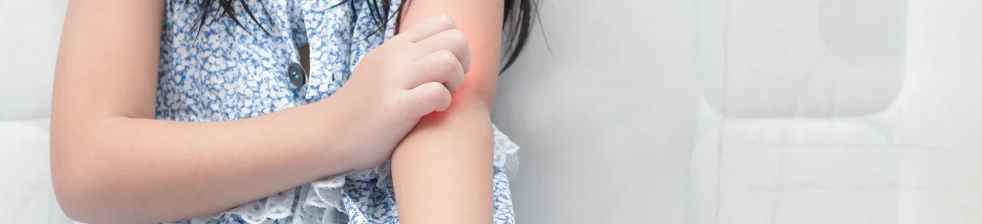 Ketahui Penyebab, Gejala, dan Cara Mengatasi Biduran pada Anak
