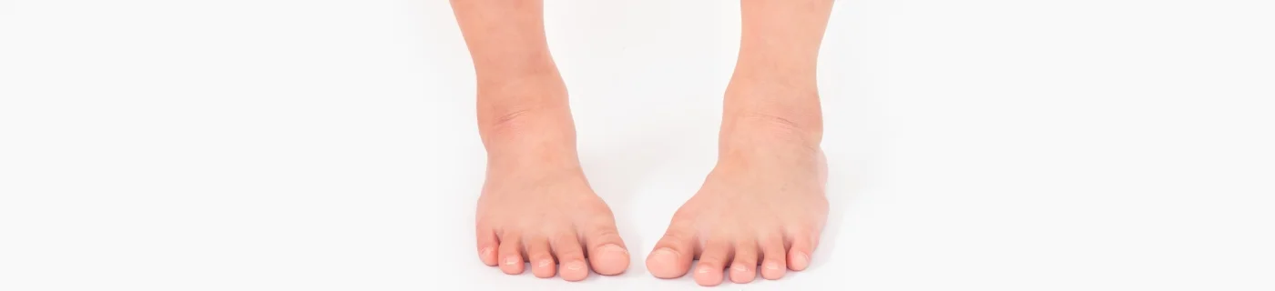 Bentuk kaki O - Nutriclub
