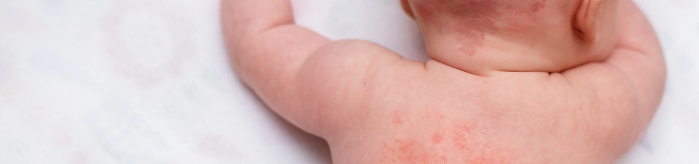 Banner Artikel Biang Keringat pada Bayi: Penyebab, Gejala, Cara Mengatasi