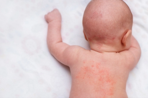 Banner Artikel Biang Keringat pada Bayi: Penyebab, Gejala, Cara Mengatasi