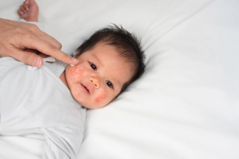 Banner Artikel Penyebab, Ciri, dan Cara Mengobati Campak pada Bayi
