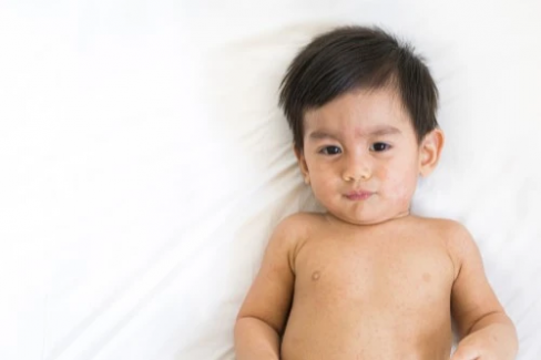 Banner Artikel Ciri-Ciri Imunisasi BCG yang Gagal pada Bayi