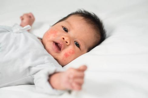 Banner Artikel 8 Penyebab Alergi pada Bayi dan Cara Mengatasinya