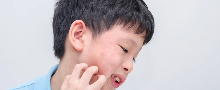 Penyebab Alergi pada Anak​ - Nutriclub