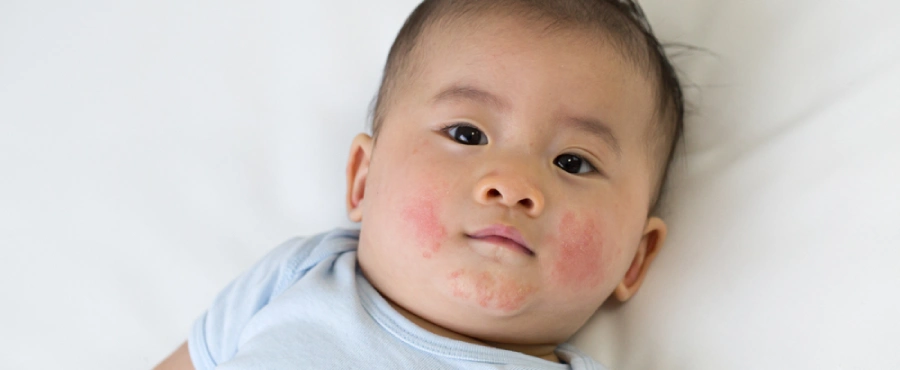 gatal pada kulit bayi-nutriclub