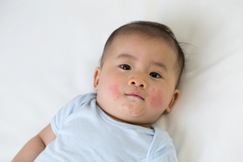 Banner Artikel 13 Jenis Gatal pada Kulit Bayi: Penyebab, Gejala, dan Cara Mengatasinya