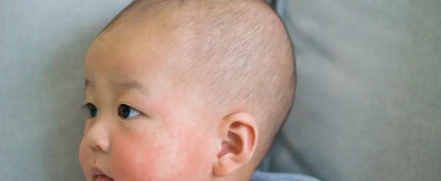 Banner Artikel Ciri-Ciri Alergi Susu Sapi pada Bayi, Penyebab, dan Penanganan