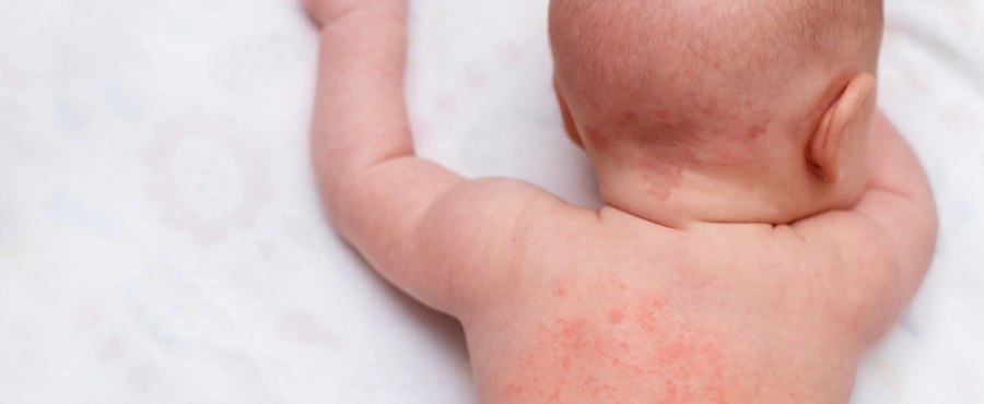 Banner Artikel 11 Cara Mengatasi Biang Keringat pada Bayi yang Aman