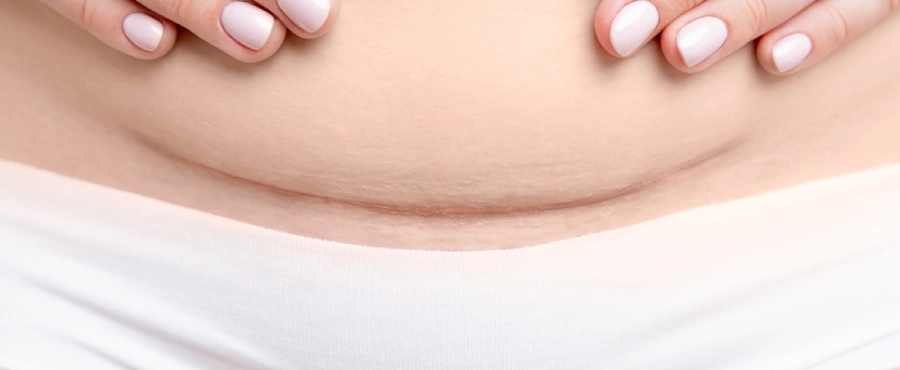 Banner Artikel Luka Caesar Sembuh Berapa Lama? Ini Tahapannya