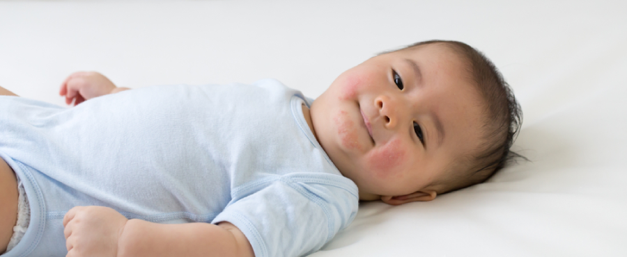 Banner Artikel Campak pada Bayi: Penyebab, Ciri, Cara Mengobati, dan Pencegahan