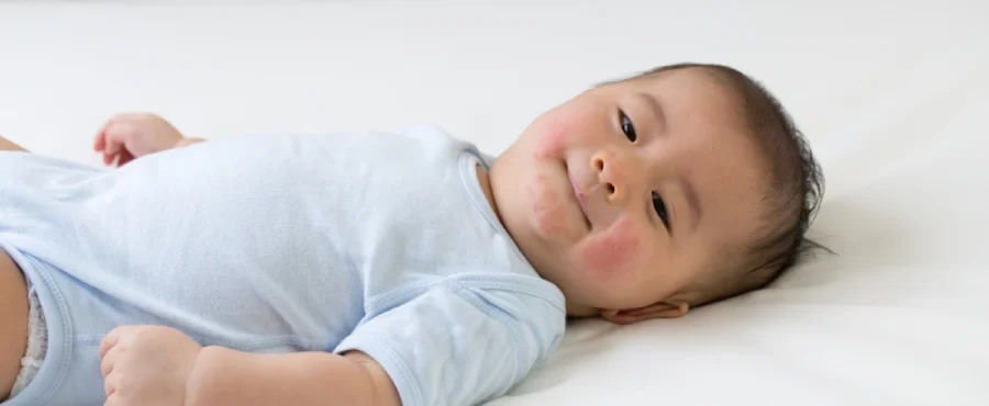 Campak pada bayi-nutriclub
