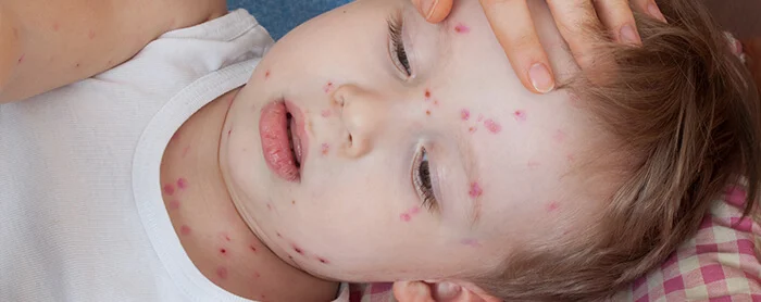 Mengenal Jenis Alergi pada Kulit Anak dan Cara Mengatasinya