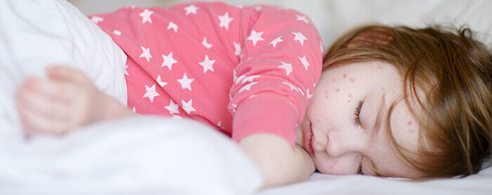 Alergi pada Bayi Baru Lahir: Ruam Kulit Anak