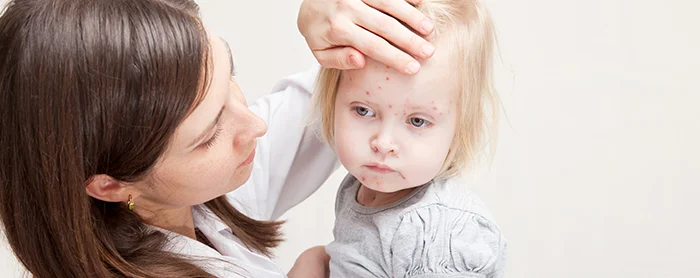 Perlukah Tes Alergi pada Anak
