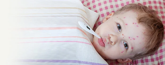 Penyebab, Ciri-Ciri, dan Cara Mengobati Campak pada Bayi