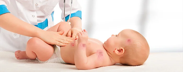 Alergi Susu Sapi: Kenali Gejala Awal dan Persiapan Periksa ke Dokter