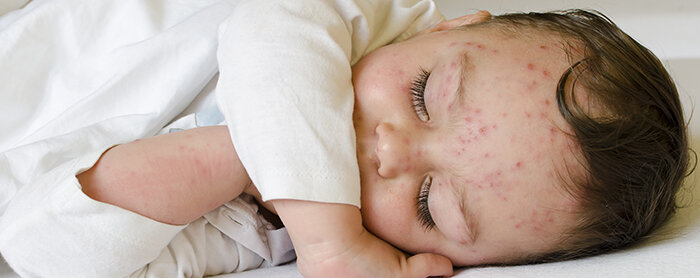 Identifikasi Gejala Awal Alergi Susu Sapi pada Bayi