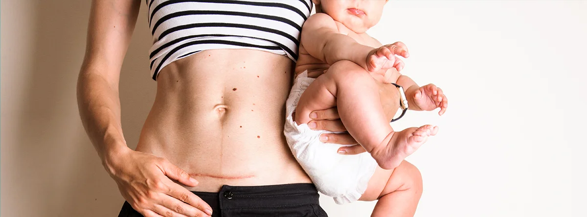 Kenali Risiko Melahirkan Caesar Bagi Ibu dan Bayi