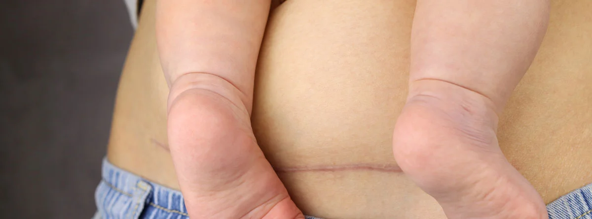 11 Tips Perawatan Pasca Operasi Caesar agar Mama Cepat Pulih